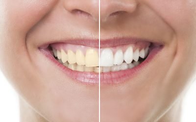 How To Treat Yellow Teeth in 5 Steps