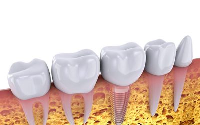 9 Things You Should Know About Dental Implants