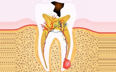 The Ultimate Guide to Root Canal Treatment in Arana Hills